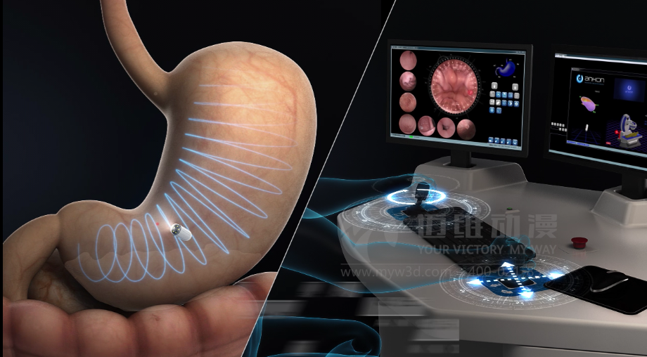 醫(yī)學(xué)醫(yī)療三維動(dòng)畫 醫(yī)學(xué)醫(yī)療三維動(dòng)畫