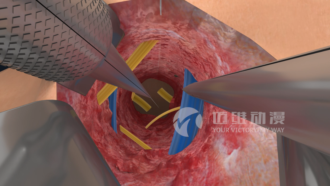 醫(yī)學(xué)手術(shù)三維動畫