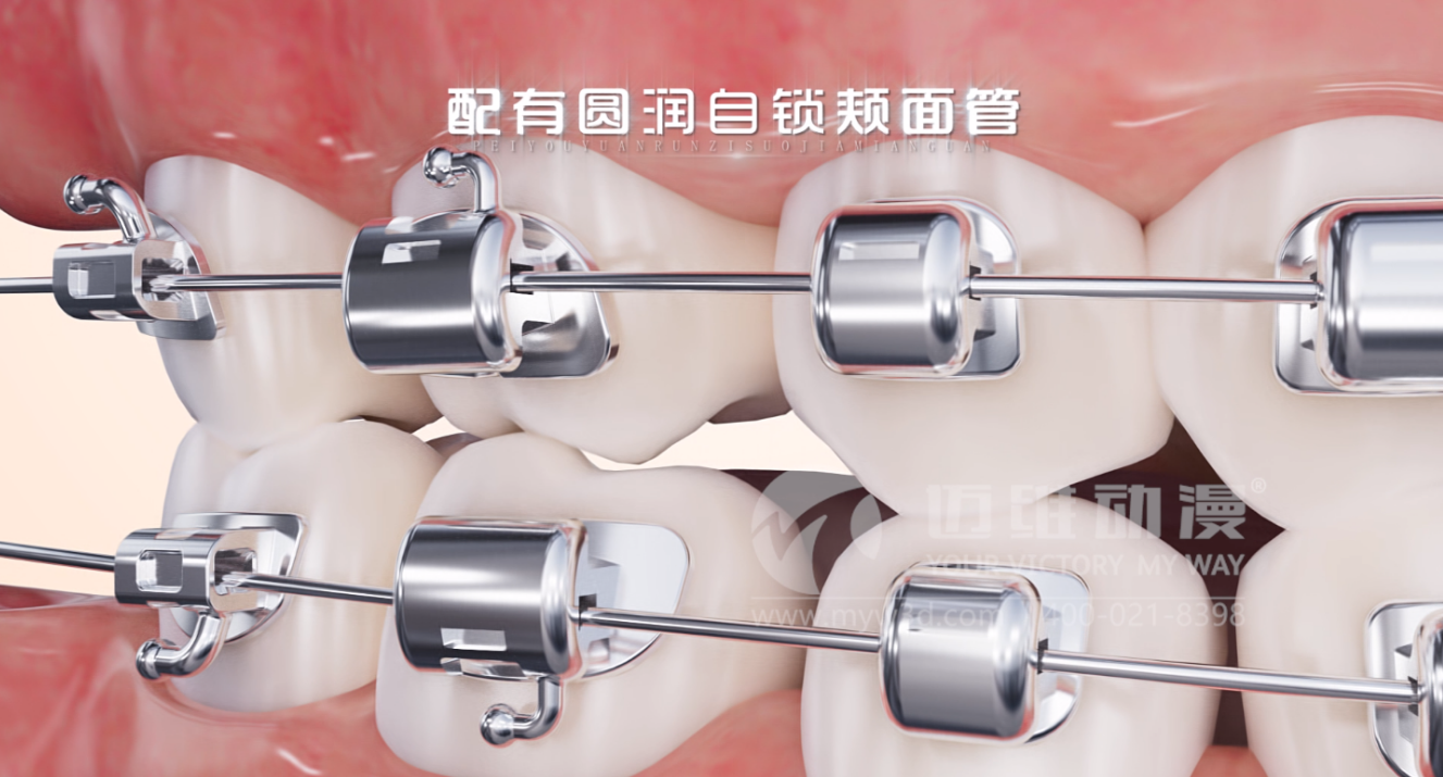 華文7D自鎖托槽產(chǎn)品展示三維動(dòng)畫(huà)(圖1) 華文7D自鎖托槽產(chǎn)品展示三維動(dòng)畫(huà)(圖1)