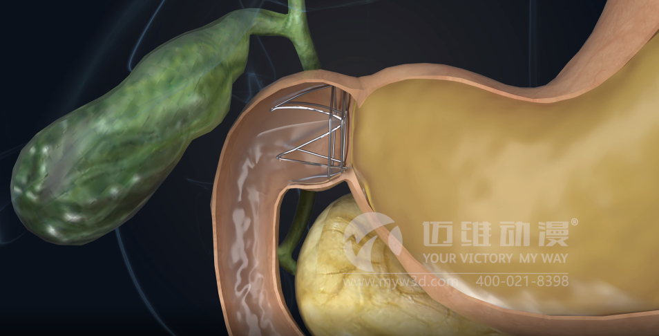 熱烈祝賀邁維動漫與杭州糖吉醫(yī)療科技有限公司圓滿完成胃轉(zhuǎn)流支架系統(tǒng)三維動畫項目合作！(圖3)