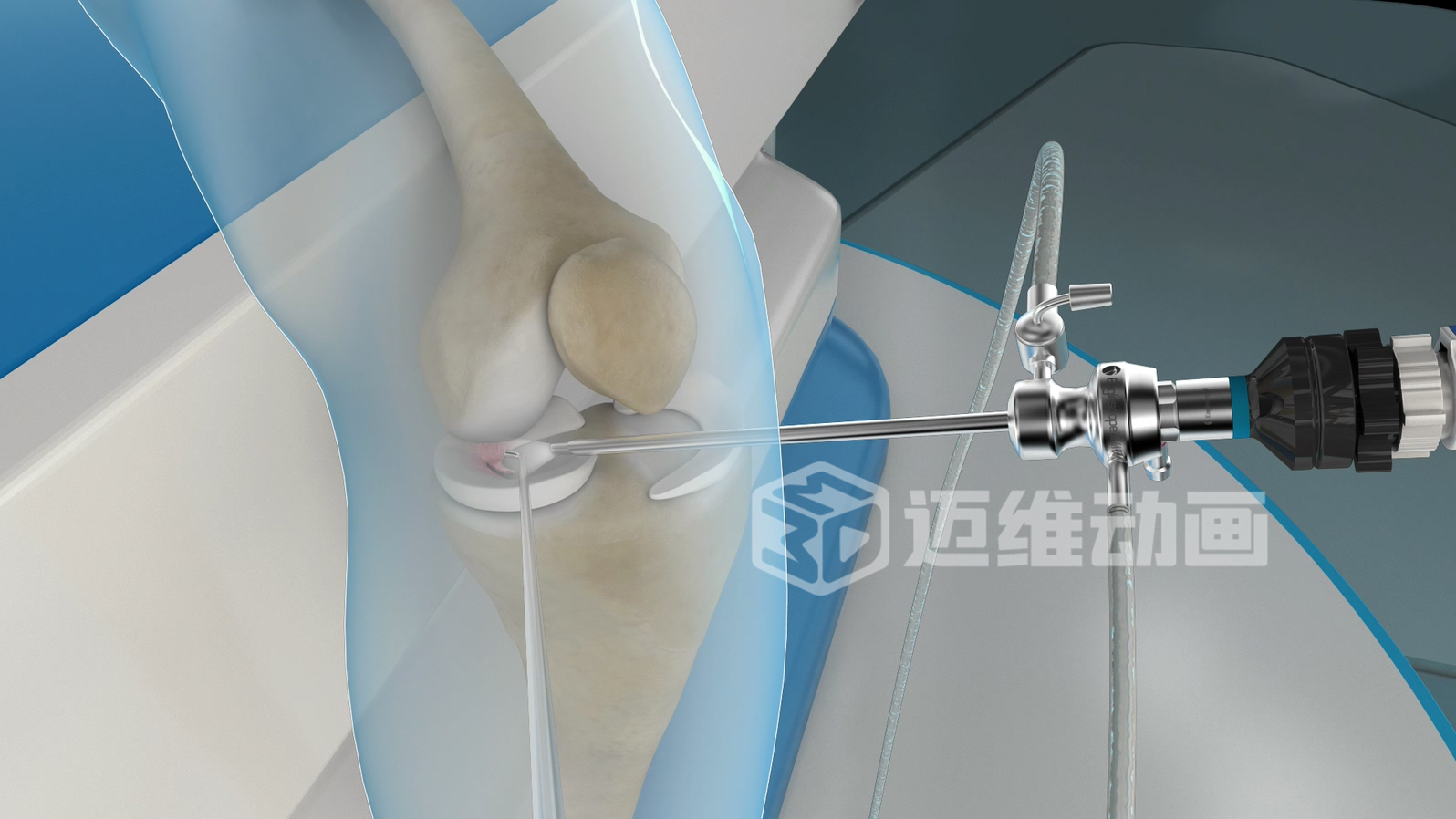 關(guān)節(jié)鏡手術(shù)三維動(dòng)畫 關(guān)節(jié)鏡手術(shù)三維動(dòng)畫