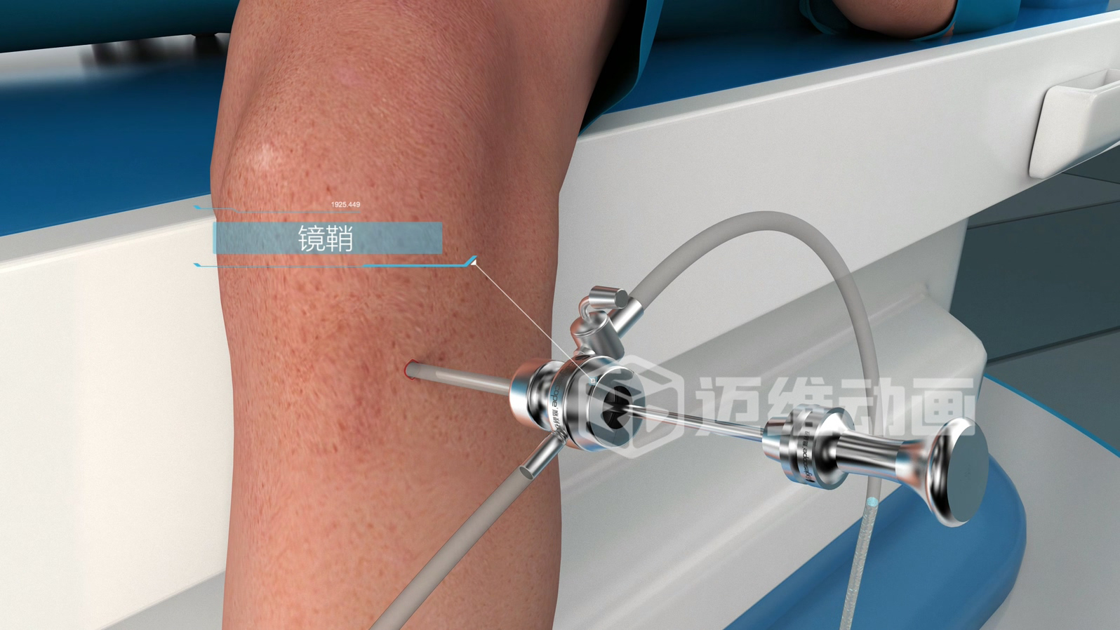 關(guān)節(jié)鏡手術(shù)三維動(dòng)畫 關(guān)節(jié)鏡手術(shù)三維動(dòng)畫